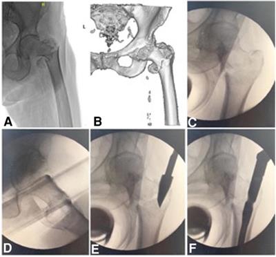 Accurate reduction of medial arch fracture fragments in intertrochanteric fractures: A novel technical note